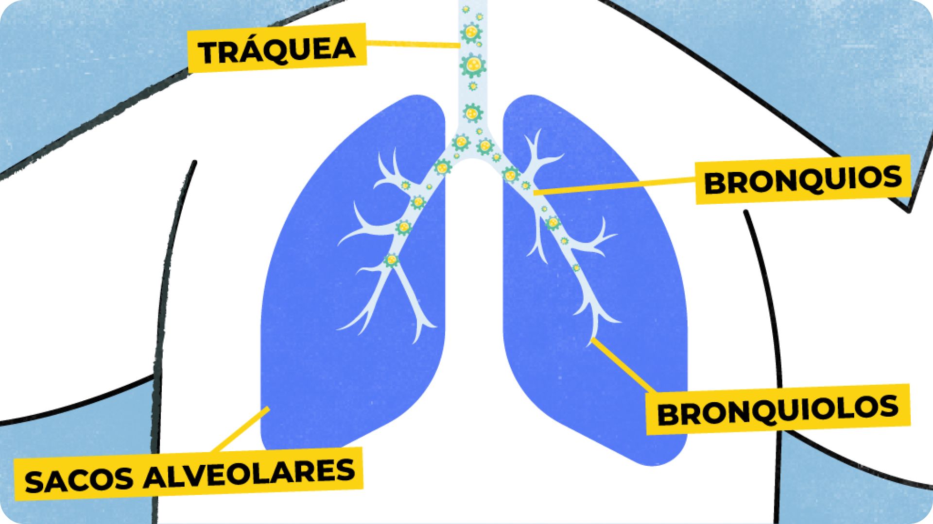 Imagen de cómo el VRS viaja al traspasar la primera barrera hacia las vías respiratorias. 