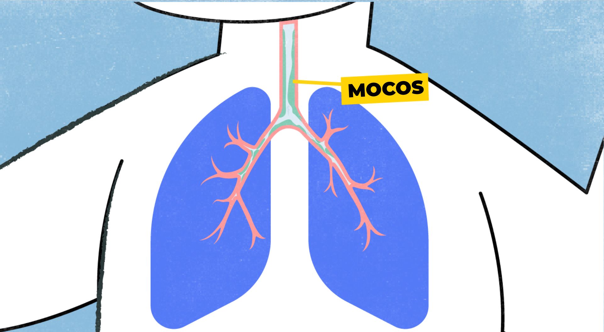 Imagen que muestra una gran acumulación de moco en las vías respiratorias, dificutando la respiración.