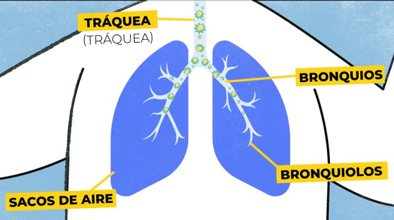 serie de imágenes explicando como el virus afecta los pulmones. El VSR se propaga rapidamente en el tracto respiratorio