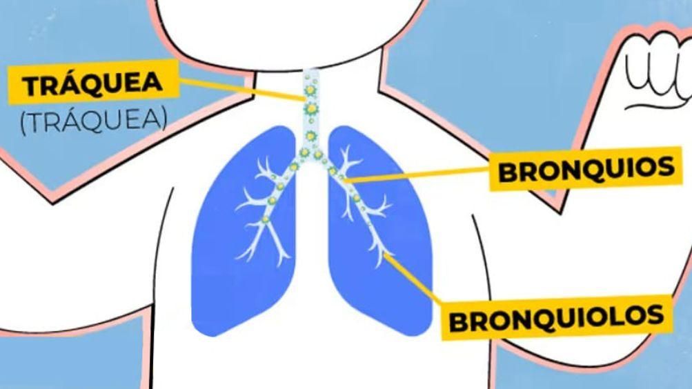 serie de imágenes explicando como el virus afecta los pulmones. El VSR se propaga rapidamente en el tracto respiratorio