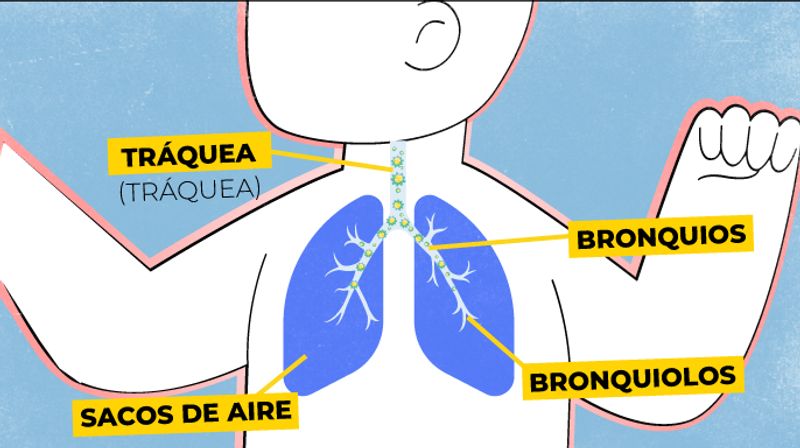 serie de imágenes explicando como el virus afecta los pulmones. El sistima inmunologico se activa