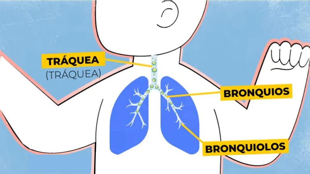 serie de imágenes explicando como el virus afecta los pulmones. El sistima inmunologico se activa