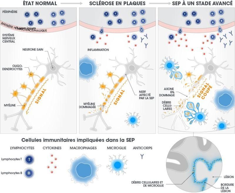 La microglie patrouille régulièrement dans le cerveau pour maintenir un environnement « propre ». Chez les patients atteints de SEP, elle s’emballe et endommage la myéline. Cela crée des débris, et la microglie réagit. Les lésions composées de microglie, de débris de myéline et d’autres cellules s’accumulent en bordure de lésion, où elles peuvent être détectées à l’aide de techniques d’IRM avancées.