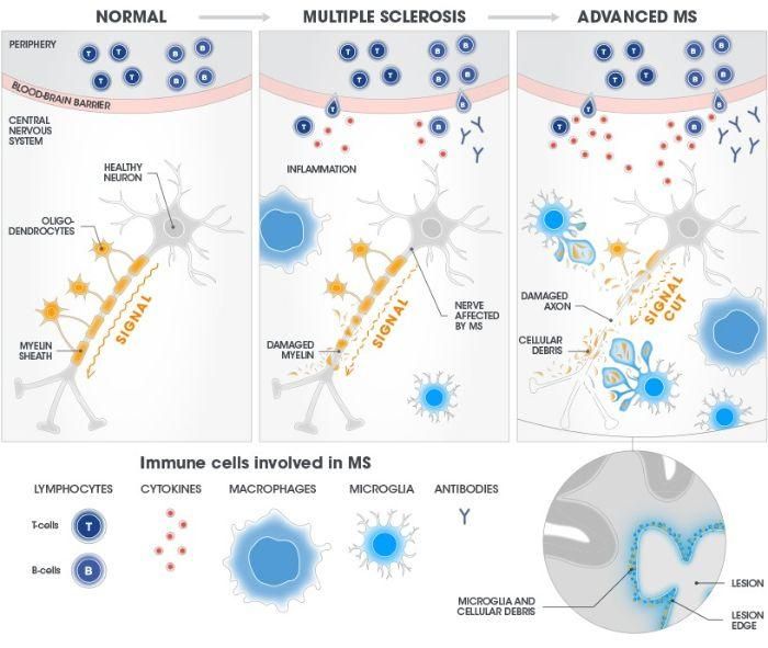 Microglia regularly patrol the brain to maintain a "clean room" environment. In MS, they go into overdrive and cause damage to the myelin sheath. This creates debris, and microglia respond. Lesions composed of microglia, myelin debris, and other cells accumulate at the lesion's edge, where they can be detected by advanced MRI techniques.