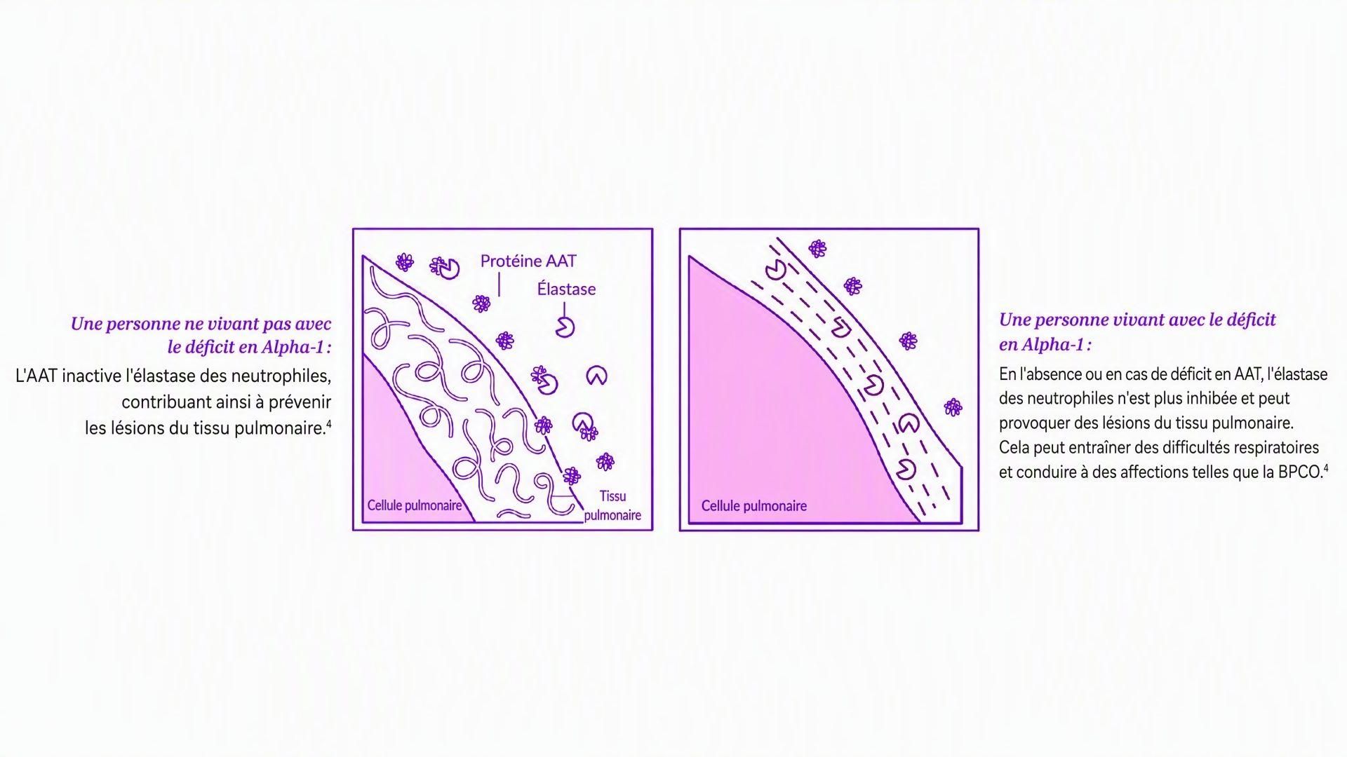 Une comparaison illustrant la façon dont l'AAT contribue à protéger le tissu pulmonaire chez les personnes non atteintes d'Alpha-1 (à gauche), tandis que chez une personne atteinte d'Alpha-1 présentant des taux réduits ou une absence d'AAT, l'élastase des neutrophiles n'est pas contrôlée et peut provoquer des lésions pulmonaires (à droite).