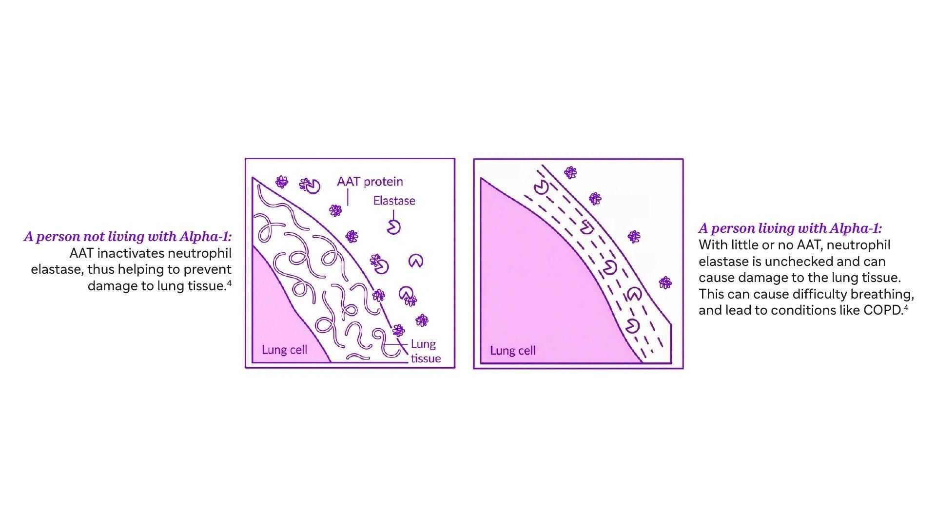 A comparison of how AAT helps protect lung tissue in people without Alpha-1 (left), while in a person with Alpha-1 who has reduced or no AAT, neutrophil elastase is left unchecked and can cause lung damage (right).