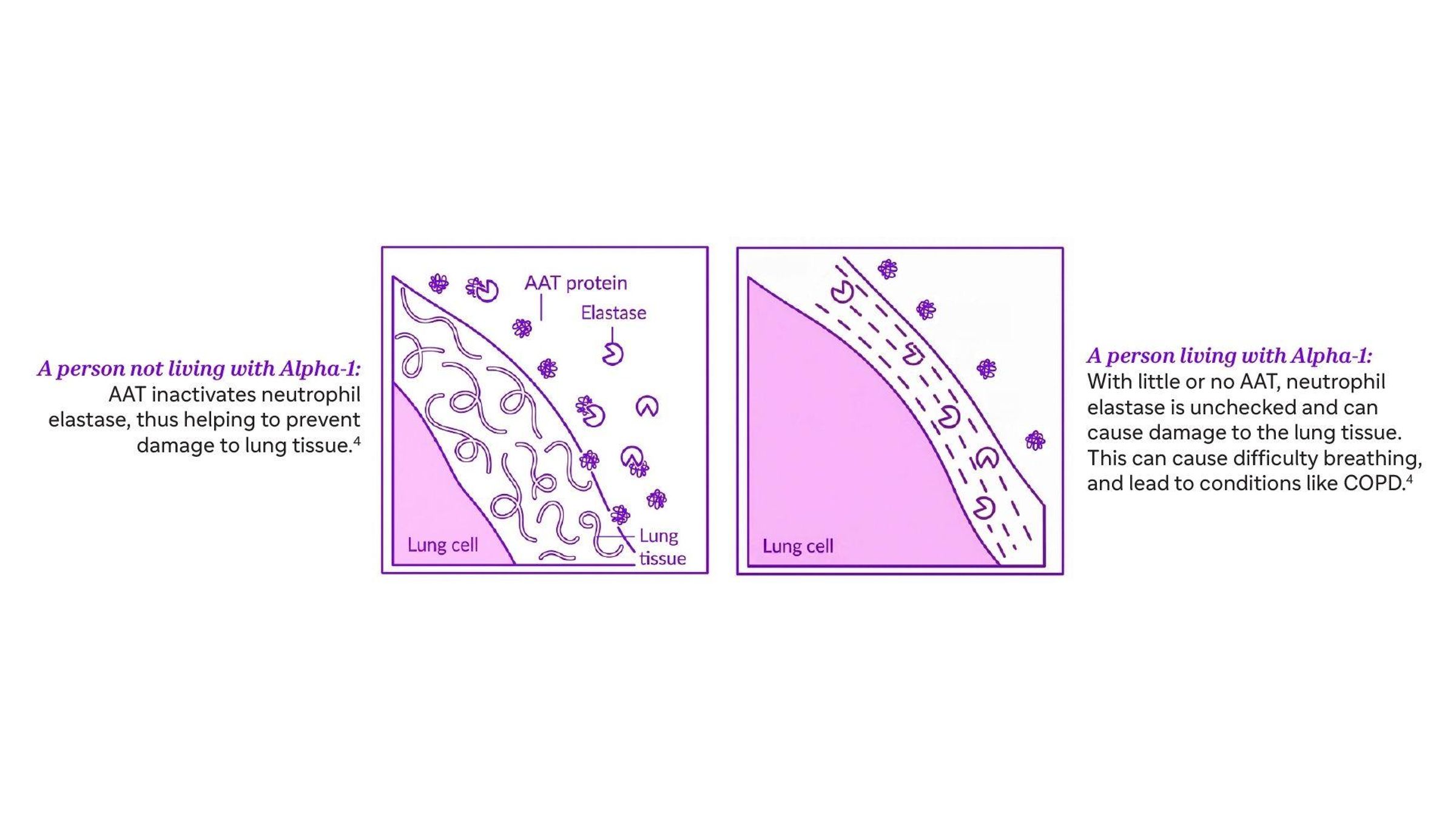 A comparison of how AAT helps protect lung tissue in people without Alpha-1 (left), while in a person with Alpha-1 who has reduced or no AAT, neutrophil elastase is left unchecked and can cause lung damage (right).